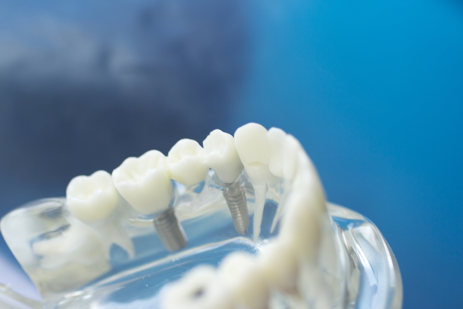 bigstock-Dental-Teeth-Mouth-Model-214863226.jpg