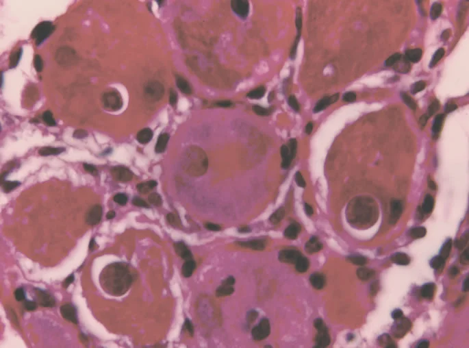 L1 inside muscle cells. 5 da post-injection. H&E