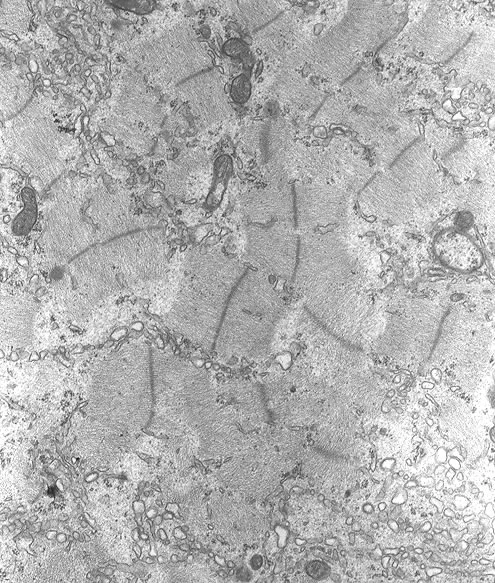 Muscle cell 8 days after injection of newborn larvae. Note disorganized A-Z complexes. TEM