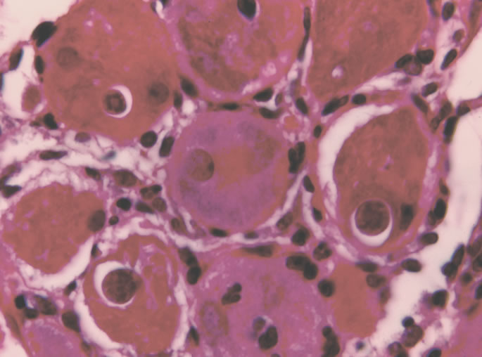 L1 inside muscle cells. 5 days post-injection. H&E