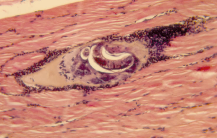 Mature nurse cell-parasite complex. Note intense inflammatory response. H&E