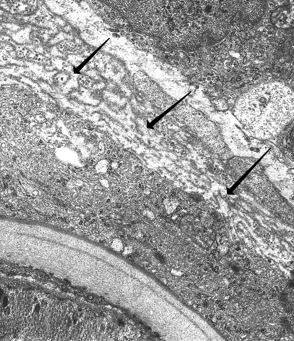 Mature Nurse cell-parasite complex. The capsule can be seen above the altered muscle cell cytoplasm.