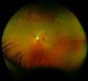 healthy-retina.jpg