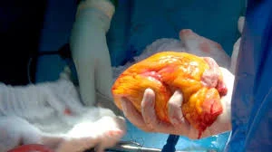 Organspende... Ja oder Nein?