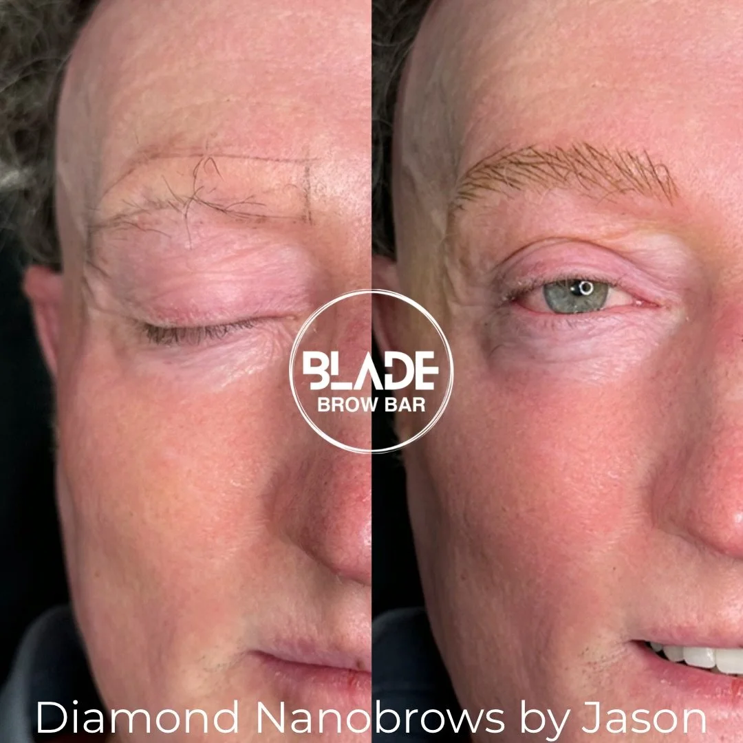 What a transformation! My favourite clients are those with no brows. This client has a form of alopecia which also causes some scarring of the skin. I could tell that some areas were a little thinner than others so the skin was a little trickier to w