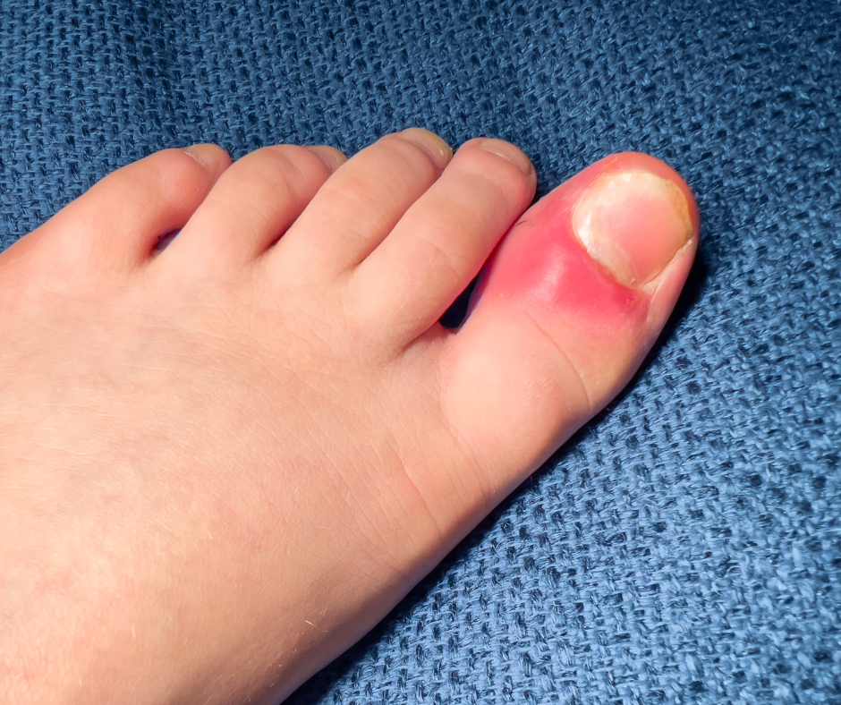 Red Human Foot Understanding Foot Redness: What It Could Mean and When to Seek Help ...