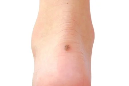 43672457_S-brown_melanoma_cancer_foot_growth_callus_blister_mole 10.10.02 AM.jpg
