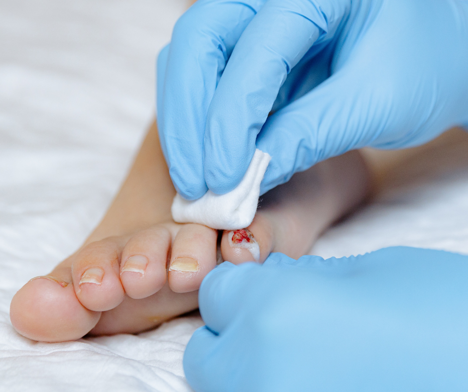 treating wound on toe