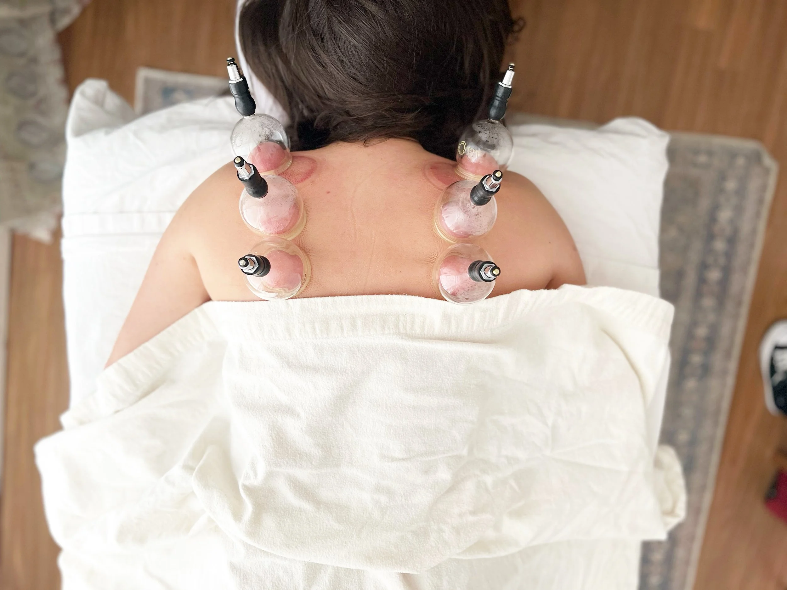 Initial Visit:  Acupuncture + Cupping:  $175