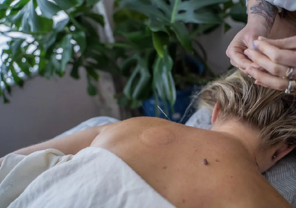 Follow up Visit:  Acupuncture + Cupping $125