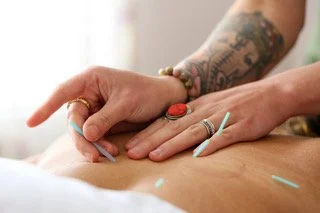 6 visits:  Acupuncture + Cupping $650