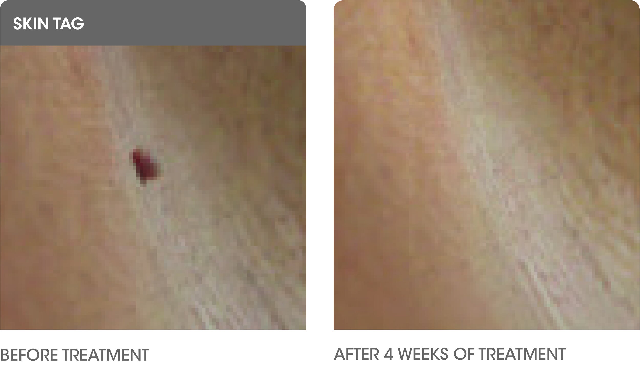 Skin Tag Before & After.jpg
