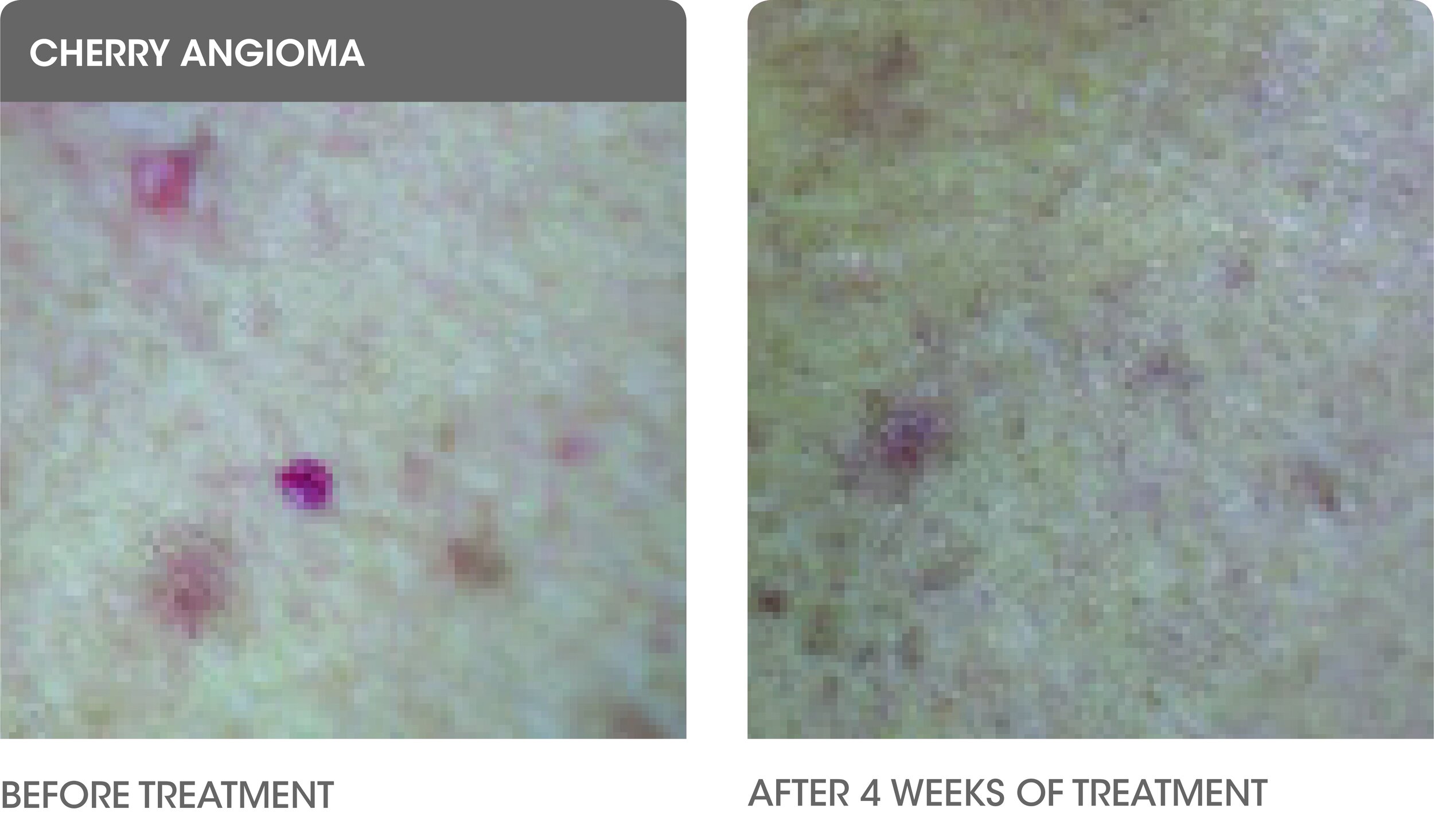 Cherry Angioma Before & After.jpg