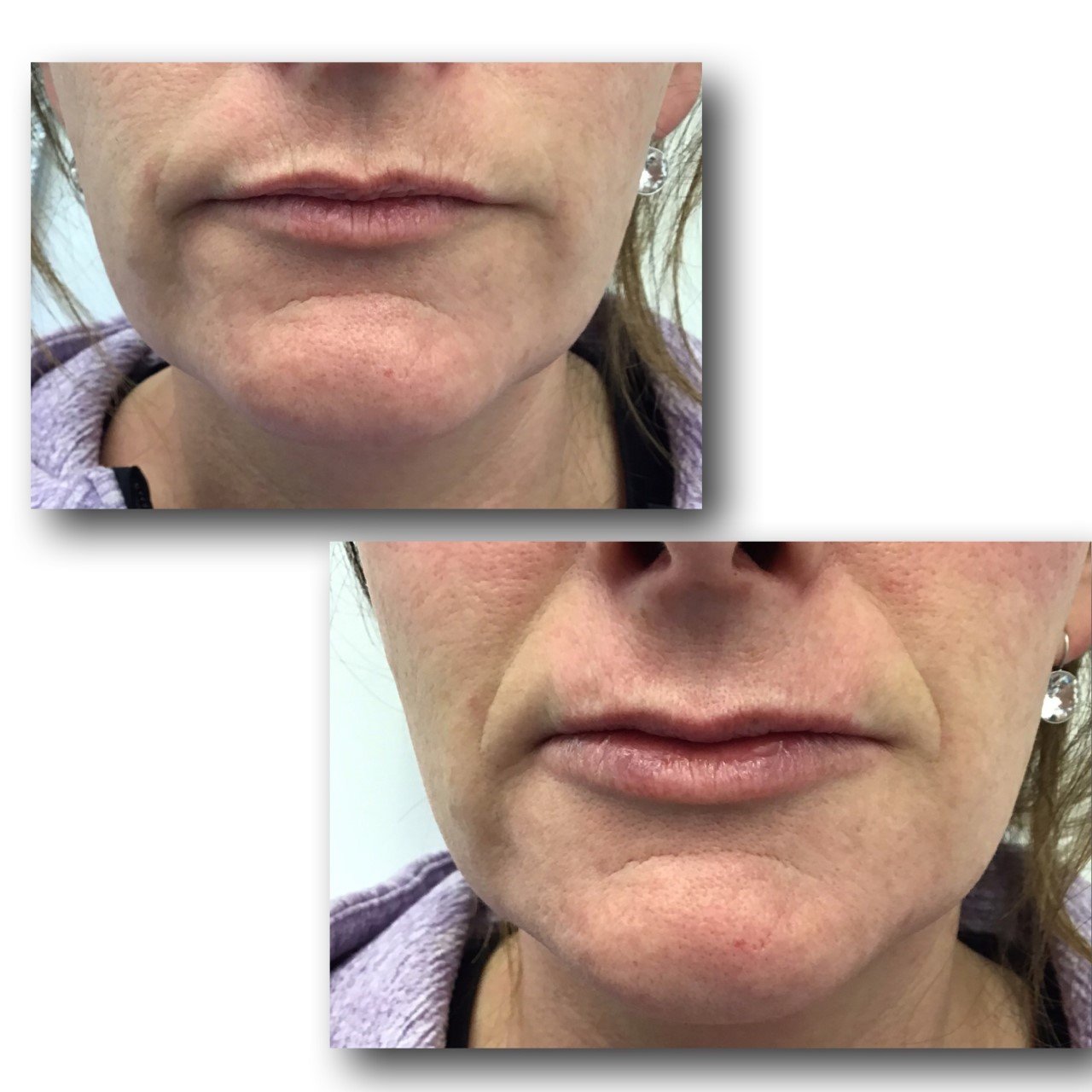 Dermal and Lip Fillers — Primrose Beauty, Laser & Aesthetic Clinic
