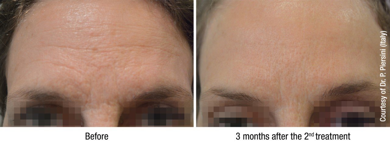 thumbnail_HYDROBOOSTER - FOREHEAD - Before & After.jpg