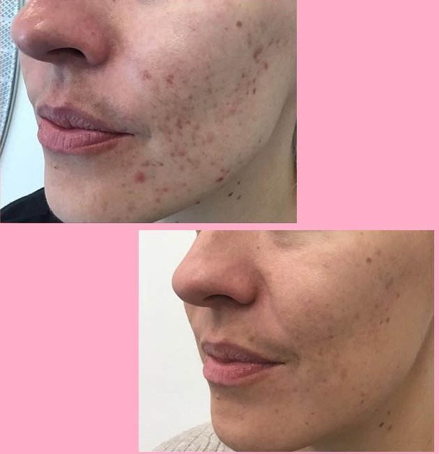 acne IPL 1.jpg