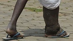 Behandlung und Information von an lymphatischer Filariose (Elephantiasis) Betroffenen durch Selbsthilfegruppen in Kenyas Küstenregion 