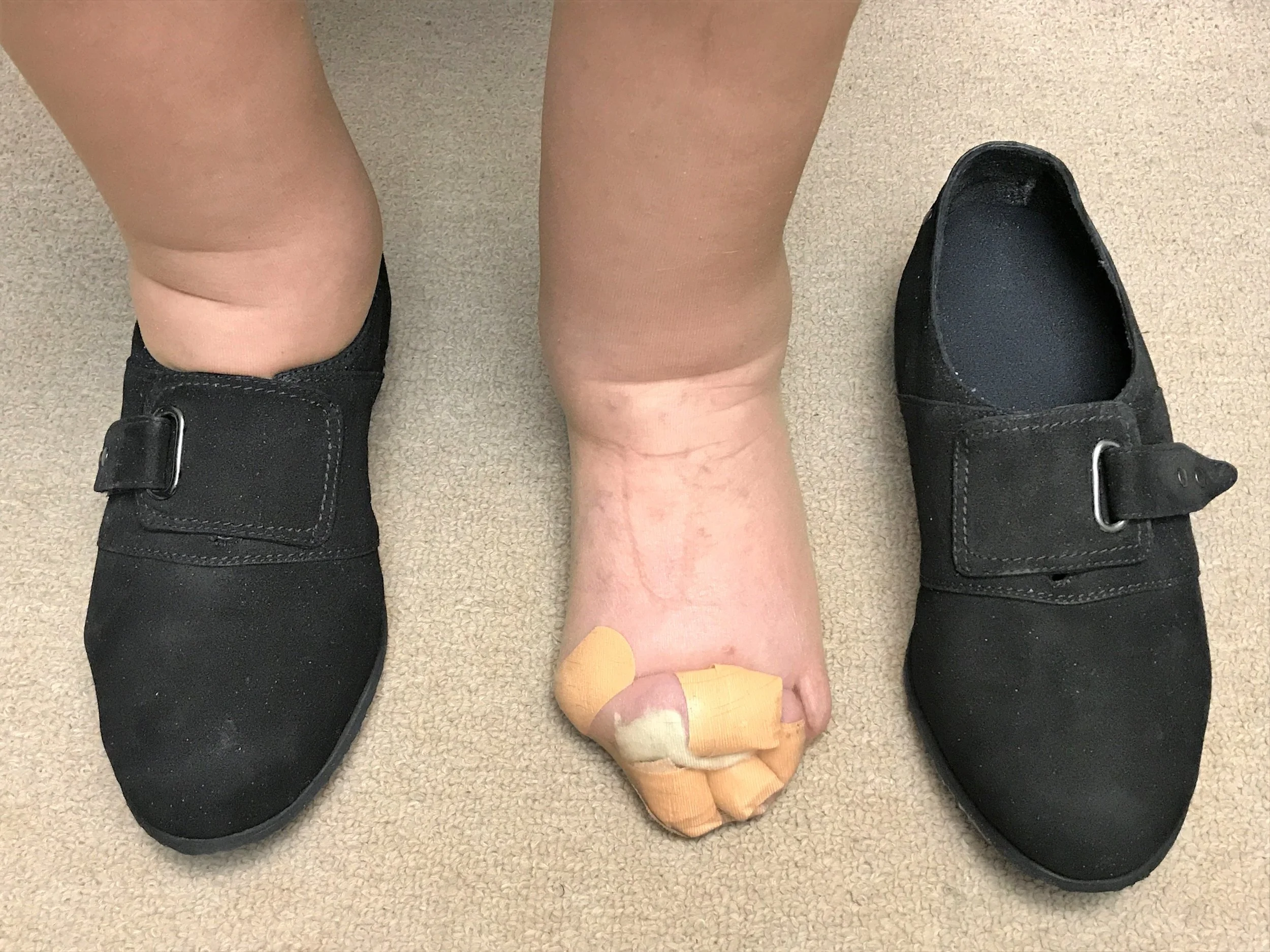 Orthopedic Shoe Upstep Custom Orthotics Cost Shoe Insoles Custom