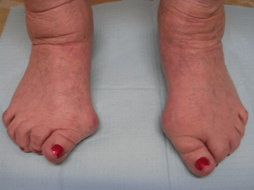 Bunions.png