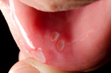 Mystery Solved: The Story on Canker Sores