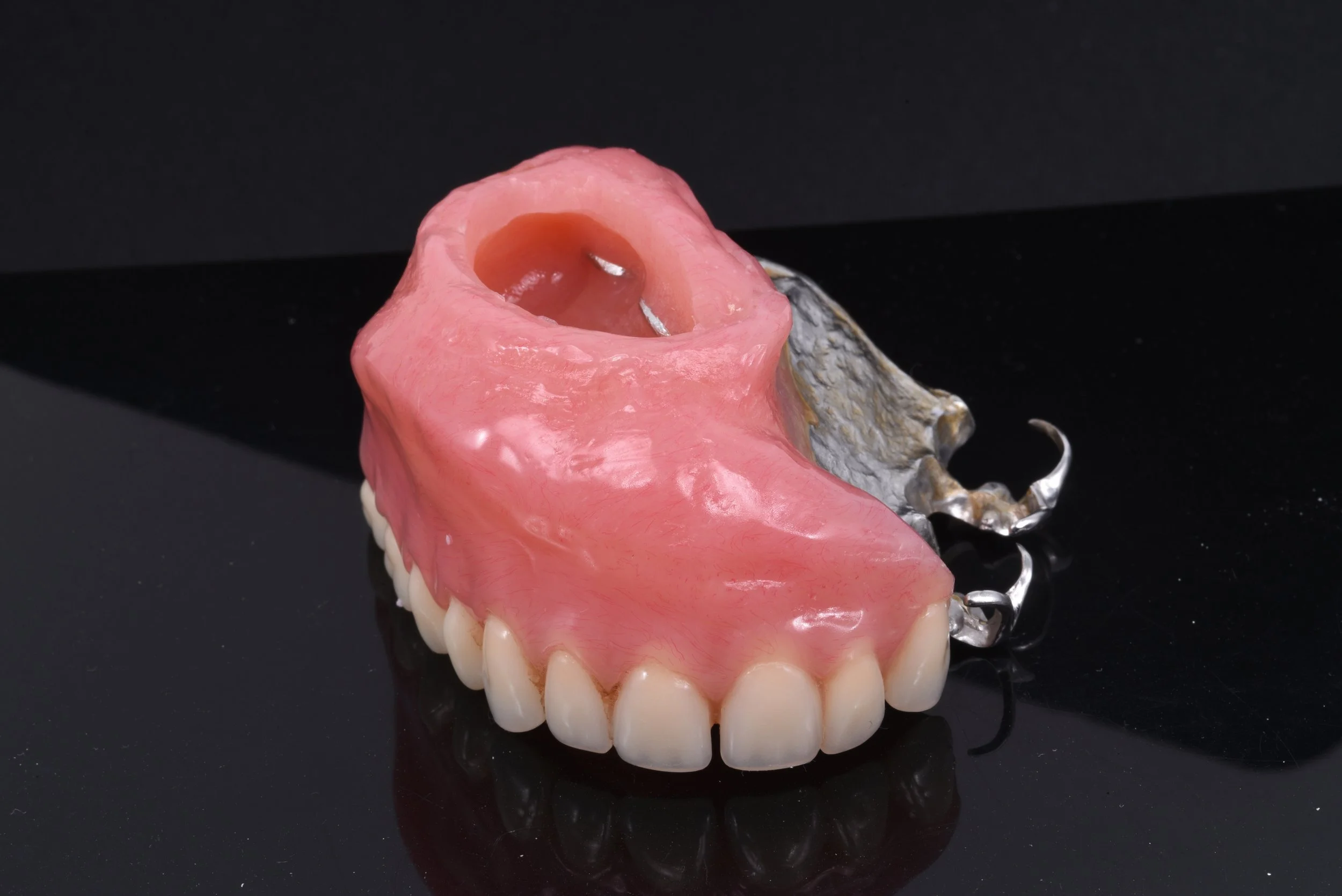 Obturator Prosthesis