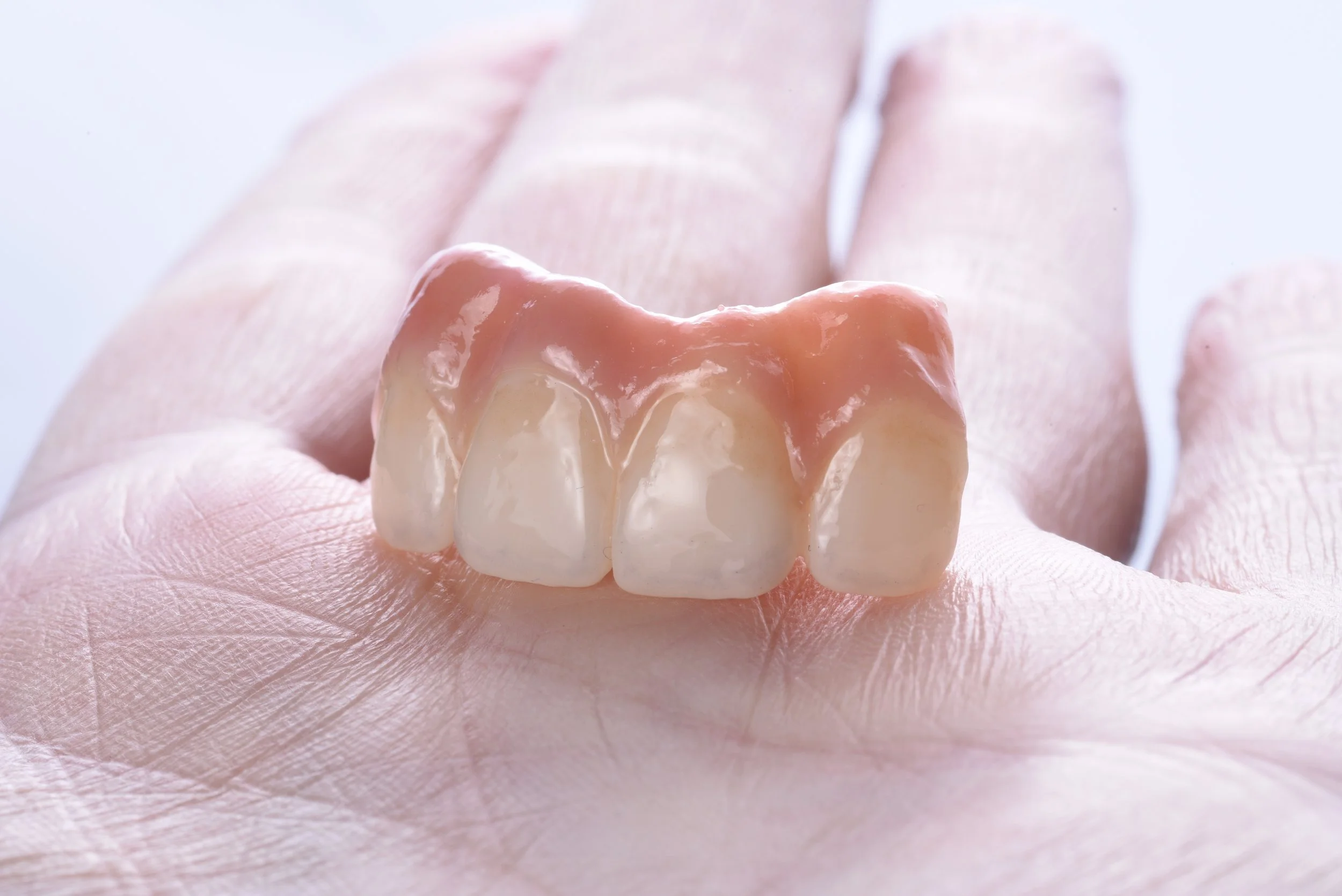 4 unit implant bridge made in house