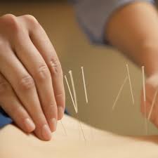 Acupuncture Square.jpg