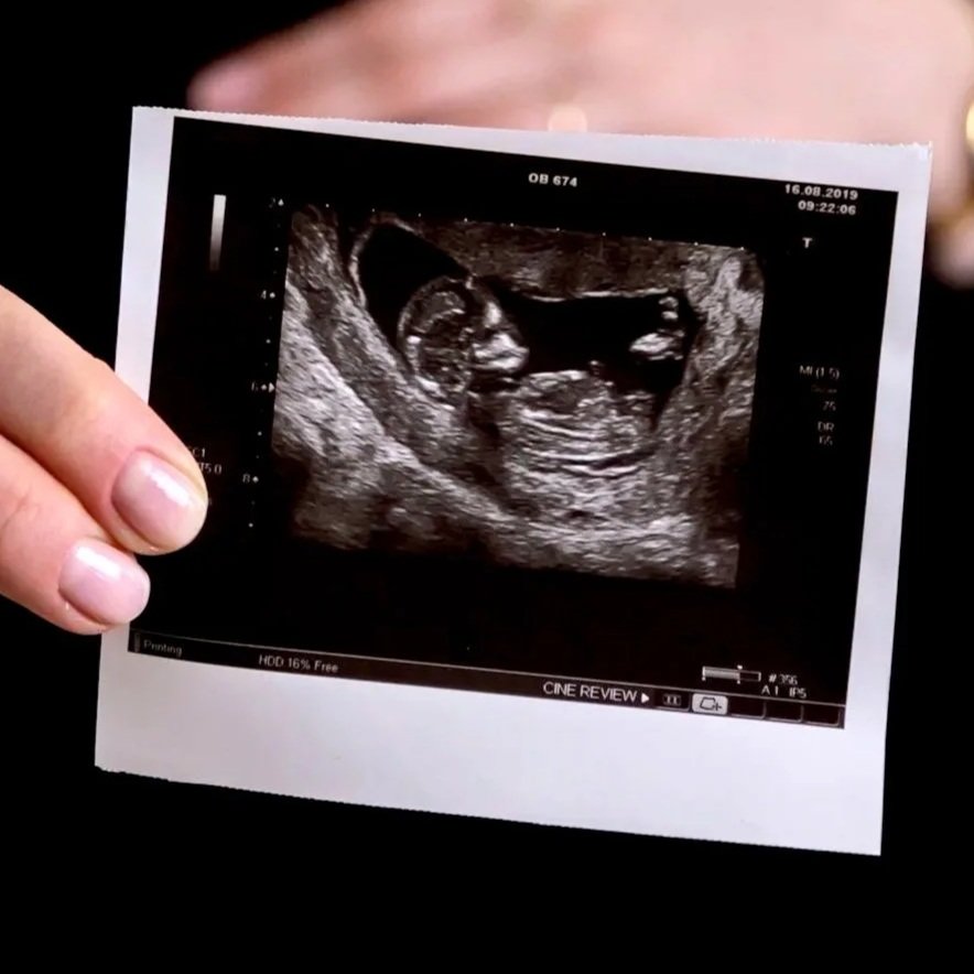 Understanding Retained Primitive Reflexes