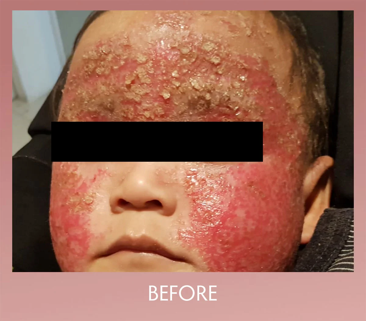 Skin Problems Healing Resonance