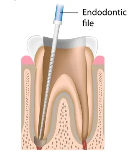 Root Canal Treatment