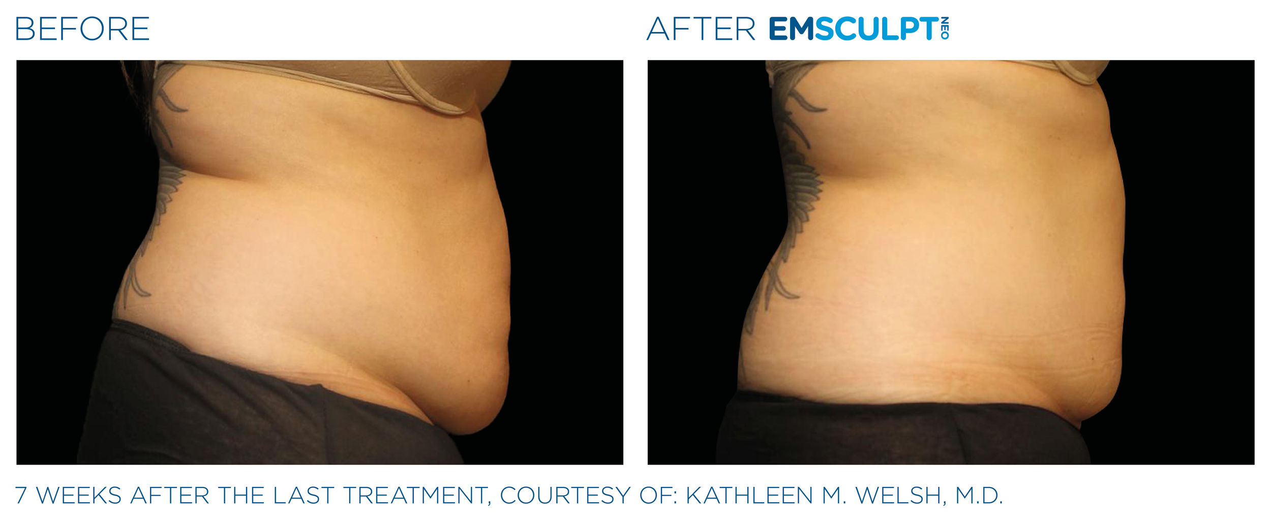 CoolSculpting Before and After Picture of Back Fat and Stomach -  Connecticut Skin Institute