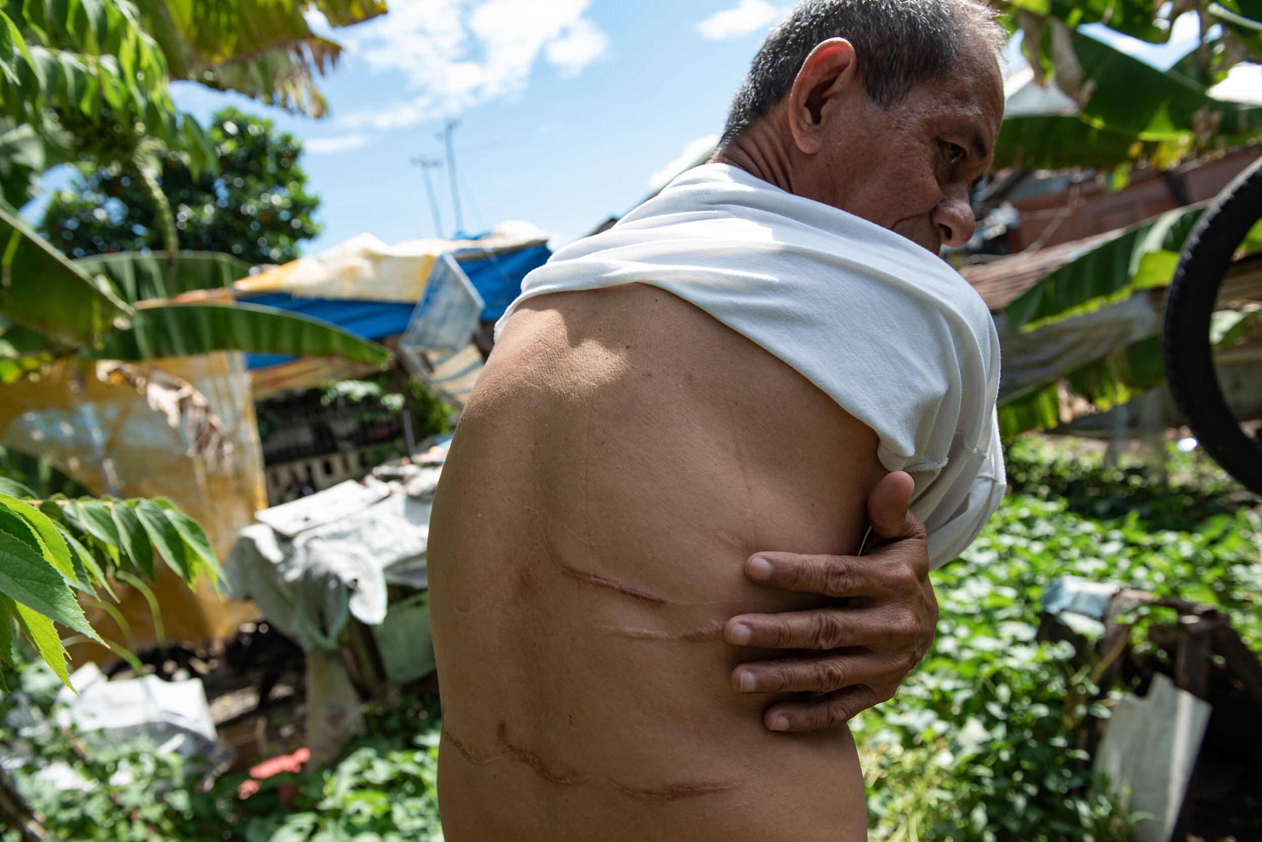  Ramon Estur, age 60, shows the scars he obtained from having been hit in the back by loose galvanized iron sheets. 