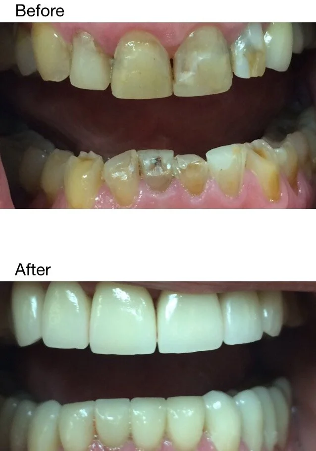 Complete occlusal rehabilitation involving 20 monolithic zirconia crowns.