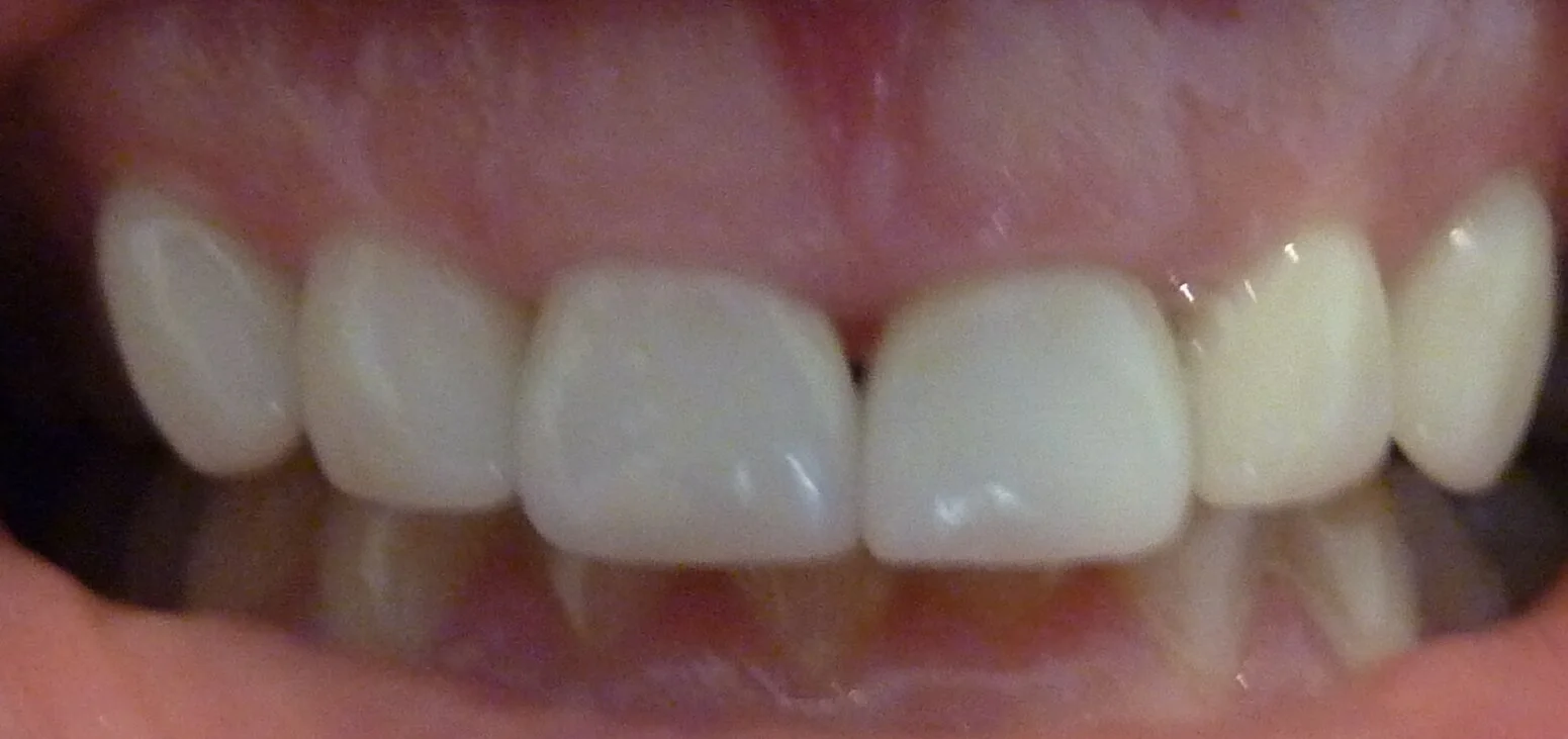 After- Aethetic rehabilitation involving 6 porcelain veneers