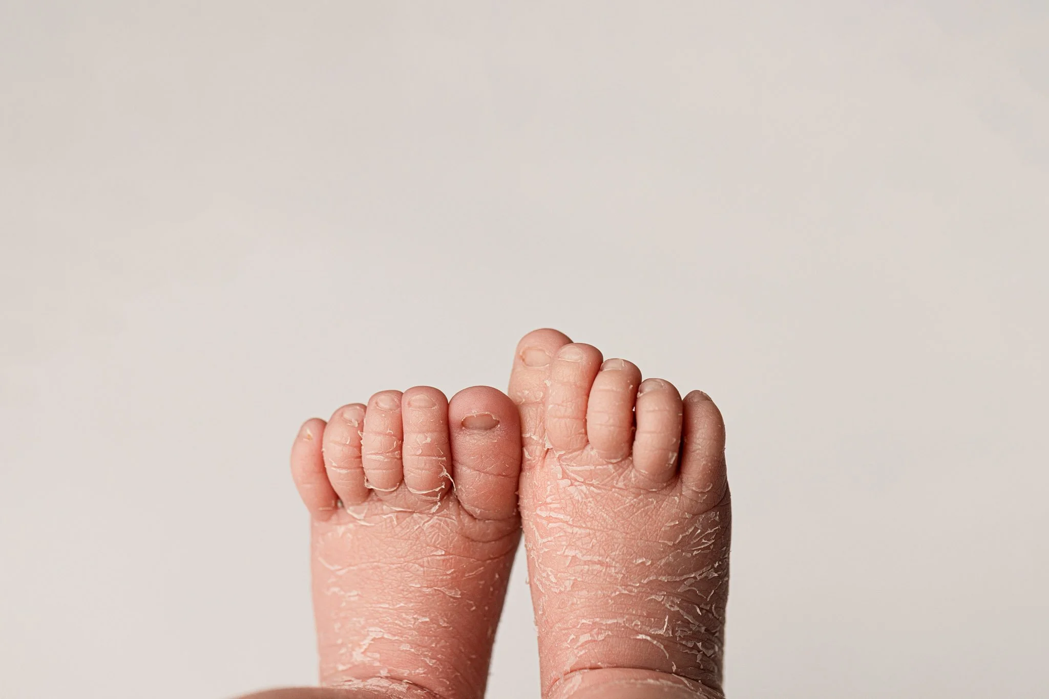 Newborn Peeling Skin Detail – Natural Baby Feet Portrait