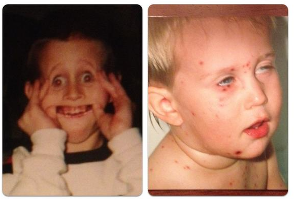 Wheeler as a young child making a face and possibly with chicken pox.