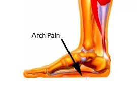 Arch Pain.jpg