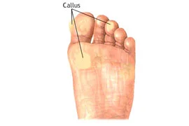 Callus.jpg