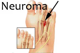 Neuroma.jpg