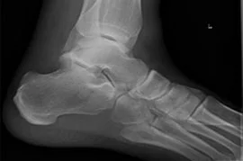 Ankle X-ray.jpg