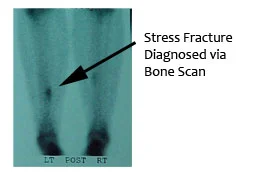 Bone Scan Stress fx.jpg