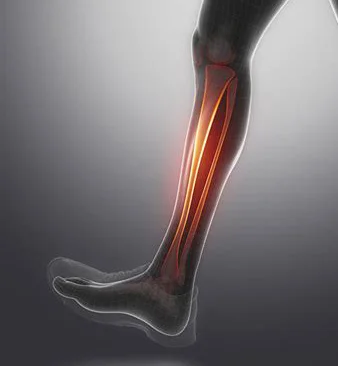 Shin Splint.jpg