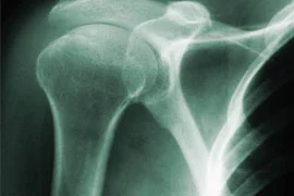 Adhesive Capsulitis X-ray.jpg