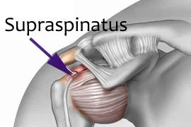 Impingement2.jpg