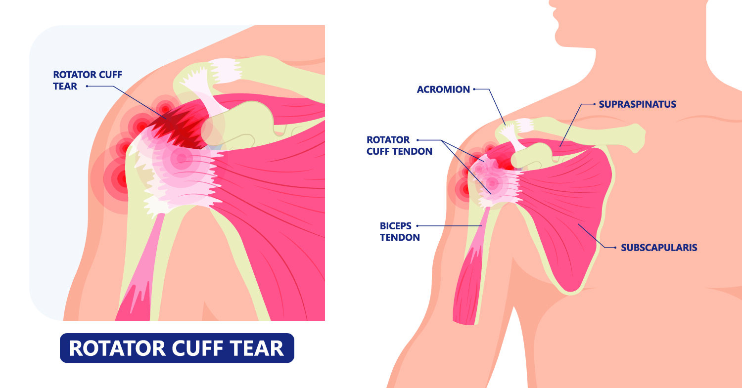 What is the rotator cuff of the shoulder? — Lake Washington