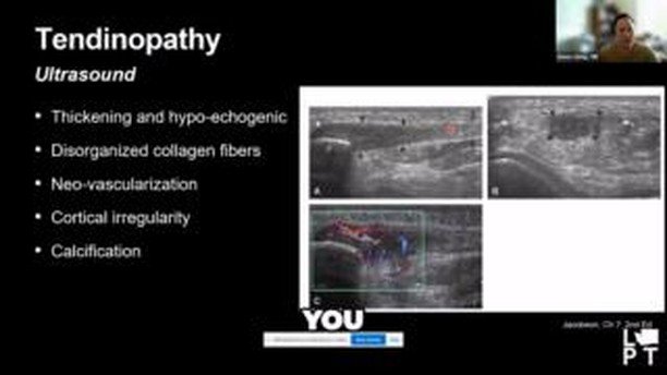 What do the fibers look like with a diagnostic ultrasound in Achilles healing ? Dr. Amos Song, MD talks about the importance of bloodflow in healing. Excerpt taken from our recent full length webinar talking about Achilles Tendon injuries.
More:
htt