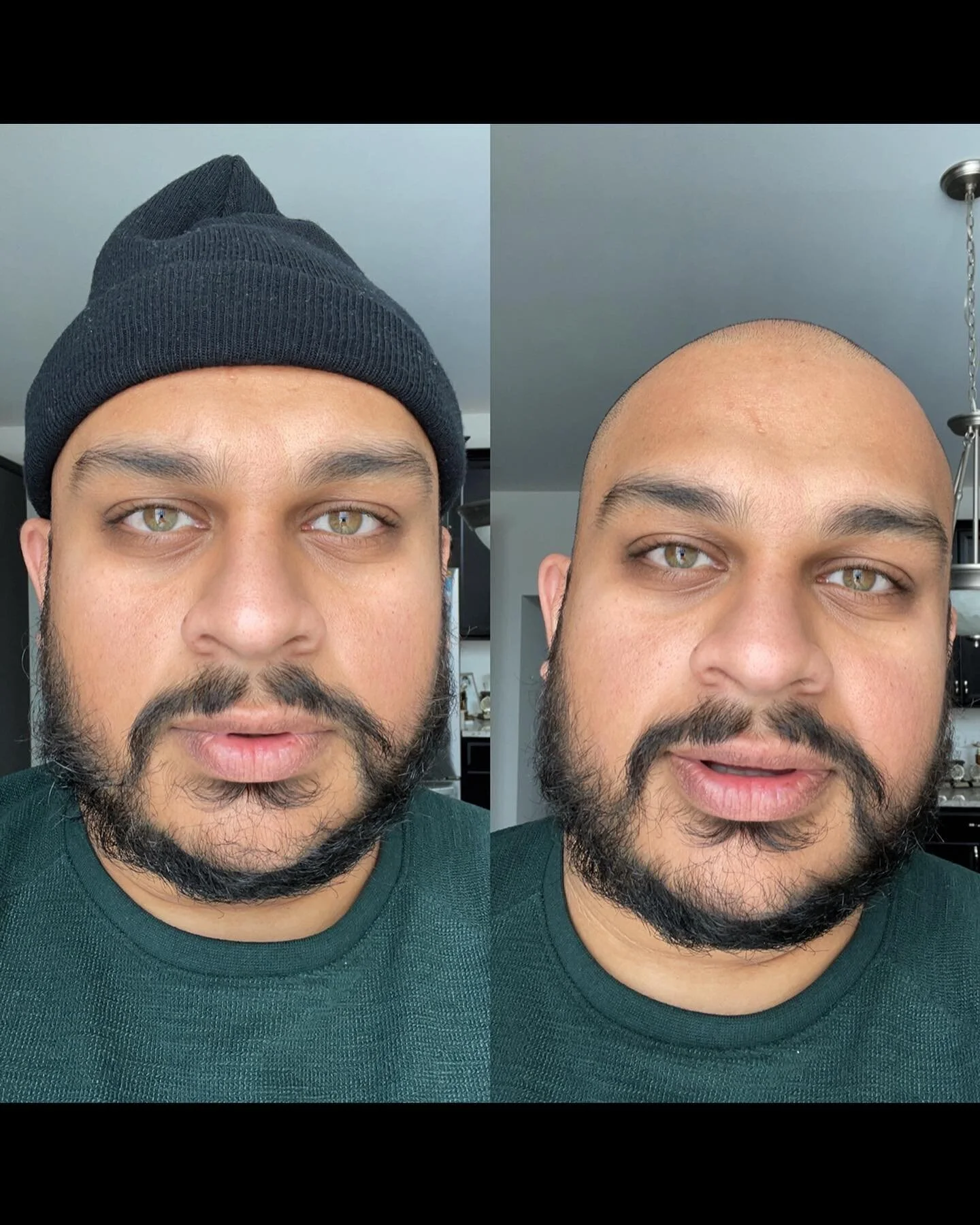 entering a new era of bald bitchery. grateful to all the bald ass bitches that paved the way before me. egg-headed heauxes, our time is now ✨🥚✨🥚✨