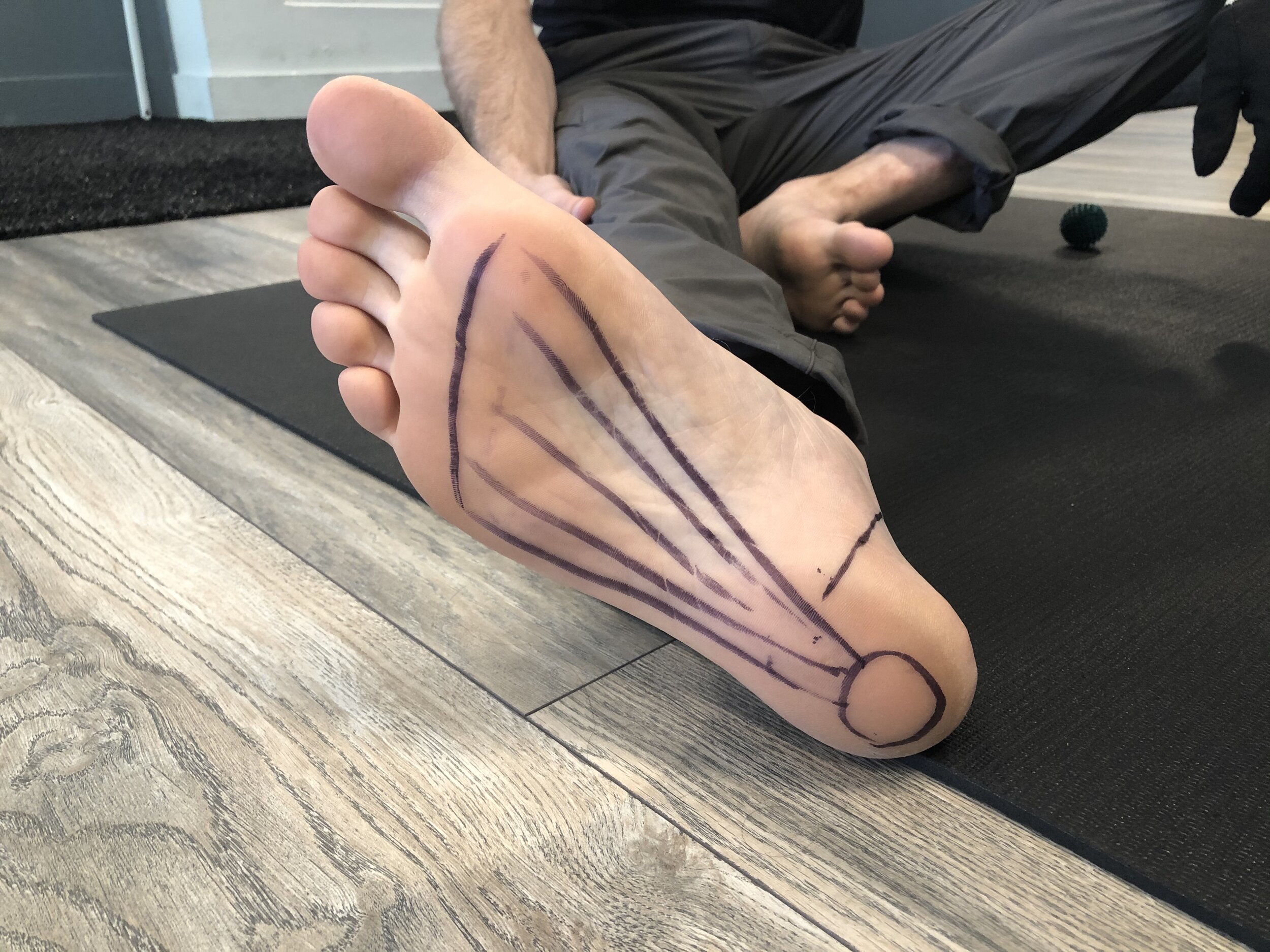 Plantar Fasciitis and Foot Pain — Crux Chiropractic