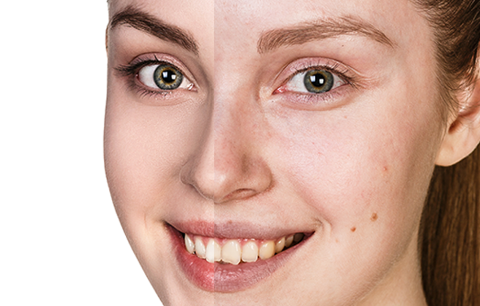 uneven skin.png