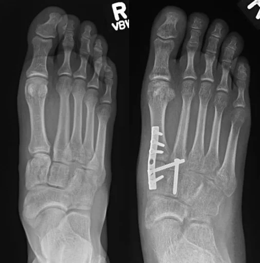 Fracture Lisfranc — Dr. Sagar J. Desai Orthopaedic Surgeon (2023)